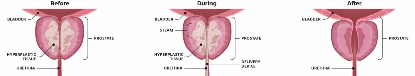 Rezum Water Vapor Therapy